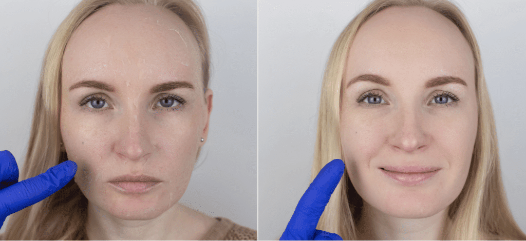 Before (left) and after (right) facial skin showing reduction in signs of aging like fine lines and uneven texture following a treatment.