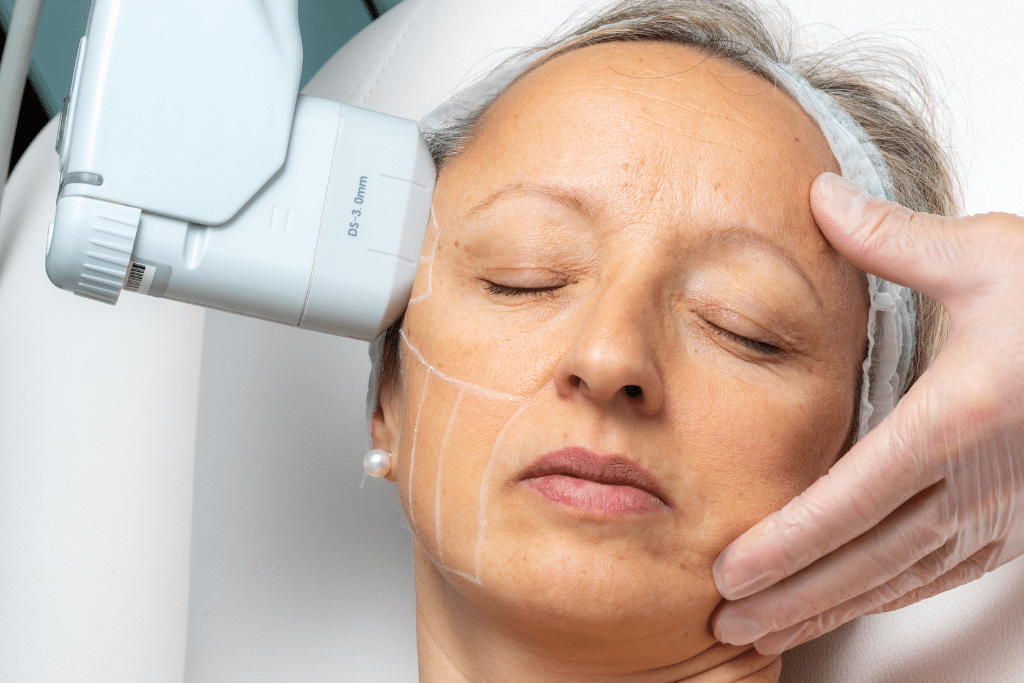 Aging skin being treated with a medical device on a mature woman's face. Lines are visible on her skin, and a gloved hand provides support.